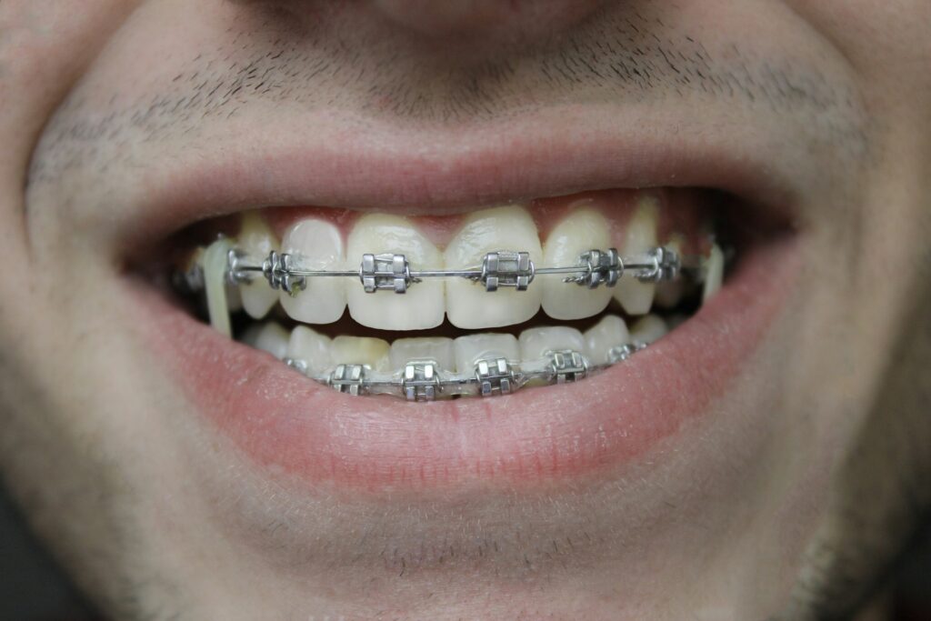 aligner